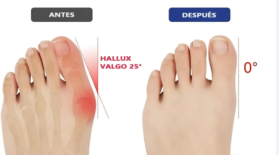 Corrector de Hallux Valgus